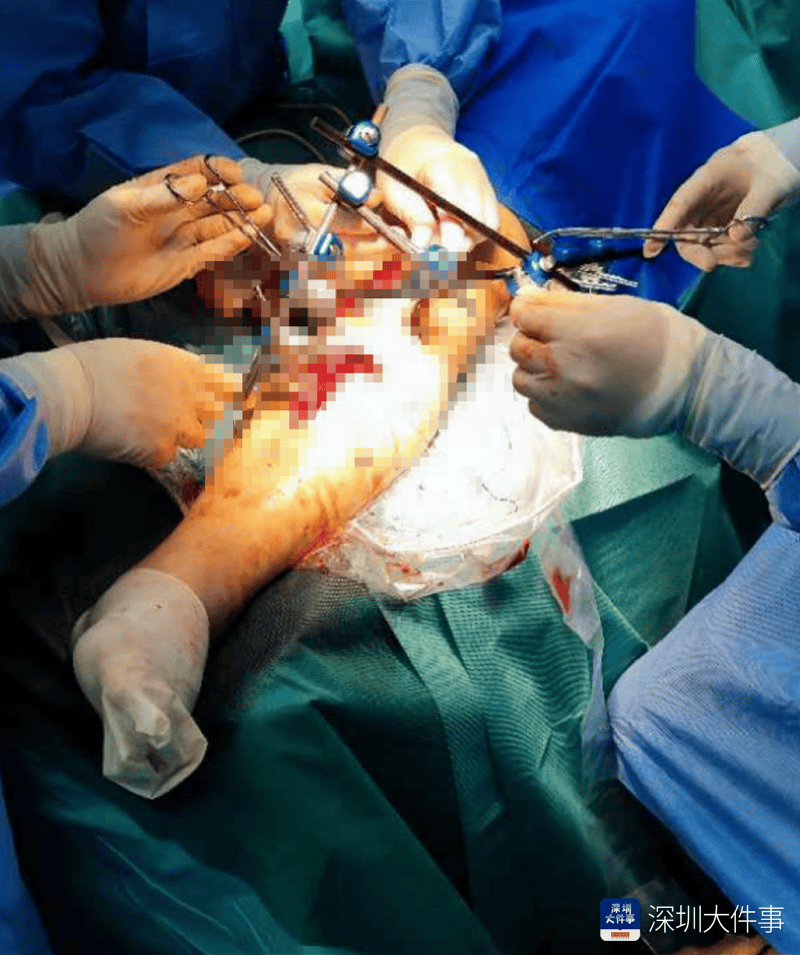 皇冠信用網哪里申请_失血过半!深圳男子被三四百斤模具砸到皇冠信用網哪里申请,医生全力抢救