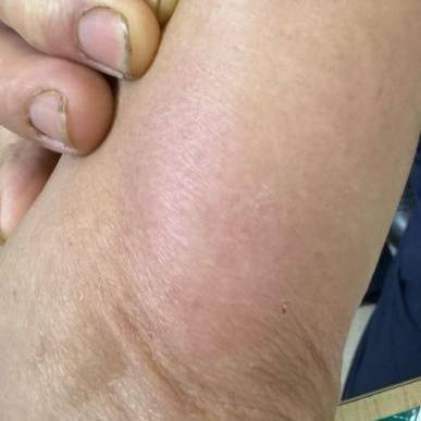 皇冠足球平台代理_杭州发生多起皇冠足球平台代理!面部肿成“馒头”!6小时内处理很重要