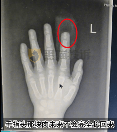 皇冠登3代理申请
_小鹏汽车回应“X9屏幕夹断5岁男童半节食指”