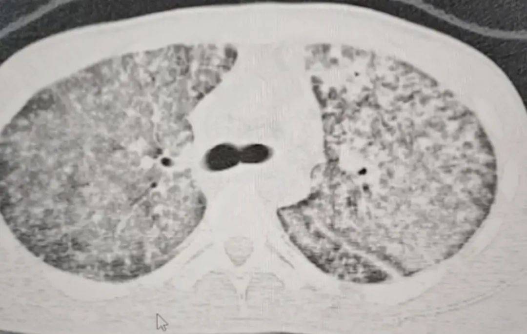 皇冠信用网开户
_河南一大学生咳嗽发烧近一月皇冠信用网开户
,多家诊所误当感冒治,医生:肺已全白