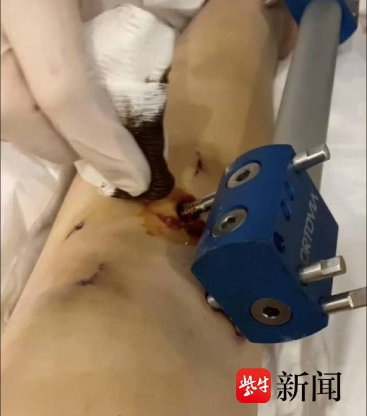 非洲足球冠军联赛
_女子去国外“断骨增高”非洲足球冠军联赛
,后遗症缠身维权难:像有定时炸弹藏在身体里