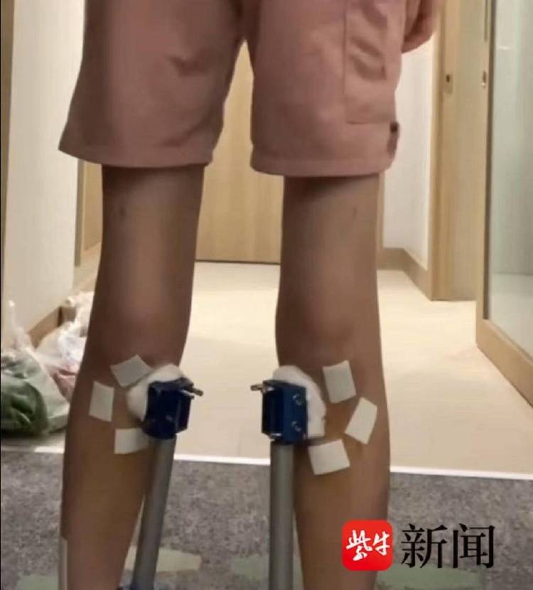 非洲足球冠军联赛
_女子去国外“断骨增高”非洲足球冠军联赛
,后遗症缠身维权难:像有定时炸弹藏在身体里