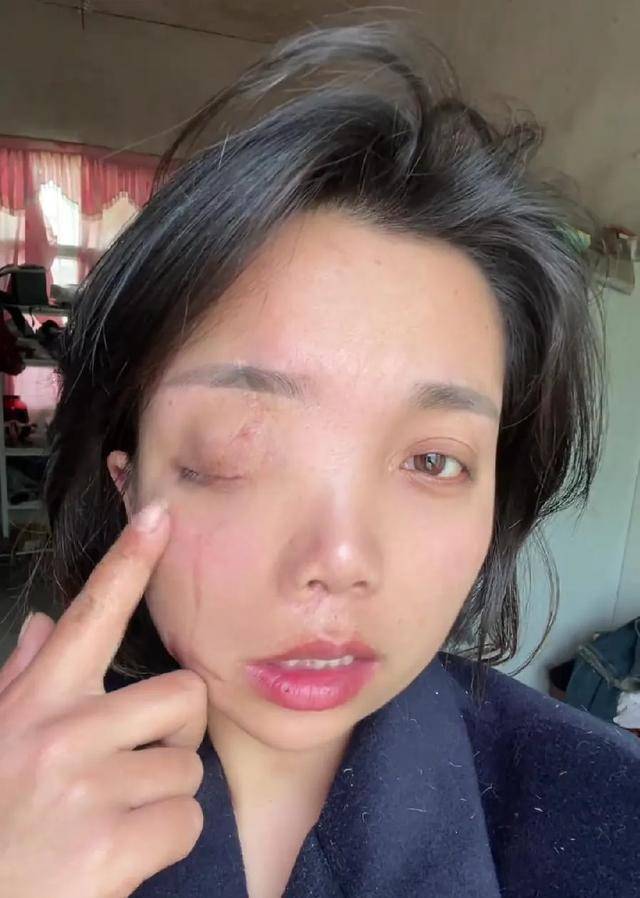 新版hga030
_安徽女子左眼失明新版hga030
,办理残疾人证被拒?残联:双眼残疾可办理