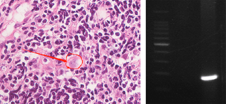2025-2026欧洲联赛冠军杯赛赛程积分_上海确诊1例!张文宏团队参与会诊!病死率极高2025-2026欧洲联赛冠军杯赛赛程积分,发病一周内迅速恶化