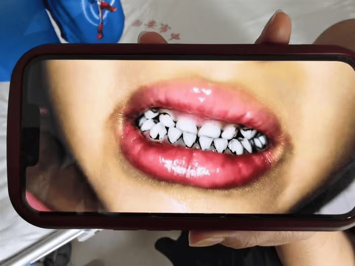 皇冠信用网开户_家长接到劝返电话“回甘肃去治”皇冠信用网开户,幼儿血铅中毒事件更多细节曝光