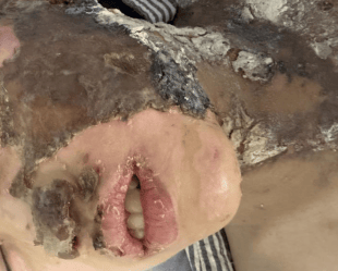 皇冠注册平台_温州一小学生实验课上被深度烧伤 后续治疗由谁负责皇冠注册平台?校方回应