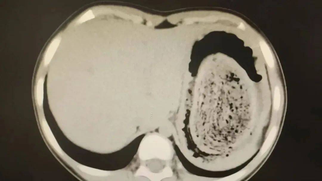 苏格兰超级联赛_发现1例苏格兰超级联赛,15岁女孩确诊!