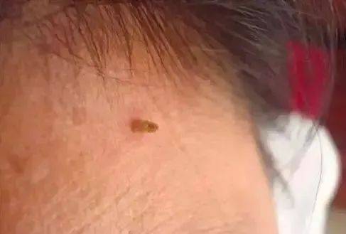 皇冠信用盘网址_脖子上长出的小肉粒皇冠信用盘网址,能揪吗?