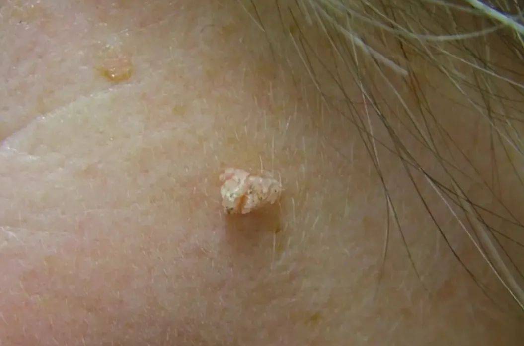 皇冠信用盘网址_脖子上长出的小肉粒皇冠信用盘网址,能揪吗?