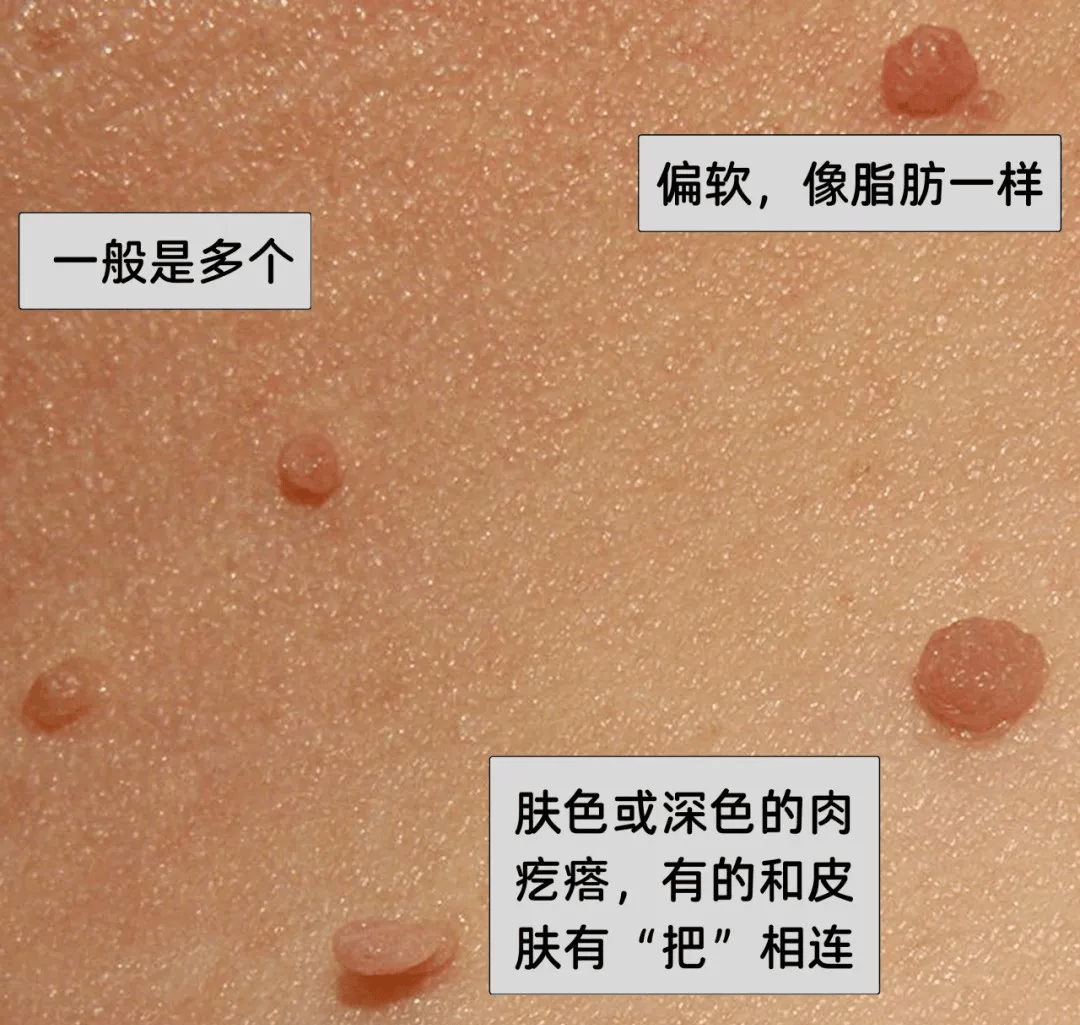 皇冠信用盘网址_脖子上长出的小肉粒皇冠信用盘网址,能揪吗?