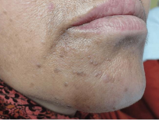 皇冠信用盘网址_脖子上长出的小肉粒皇冠信用盘网址,能揪吗?