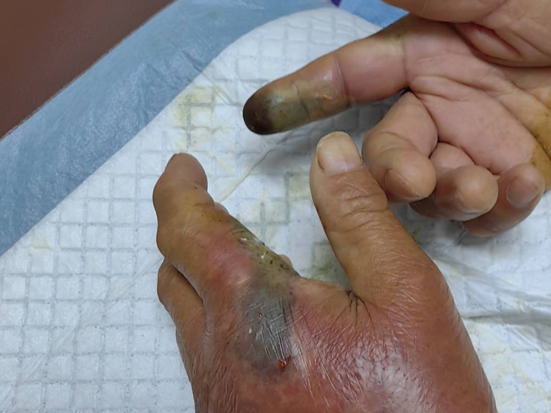 奥胡斯vs弗雷德里西亚_眼镜王蛇咬伤老人奥胡斯vs弗雷德里西亚,家属拖两米多长的“凶手”冲进医院!“拎蛇就医”可取吗?