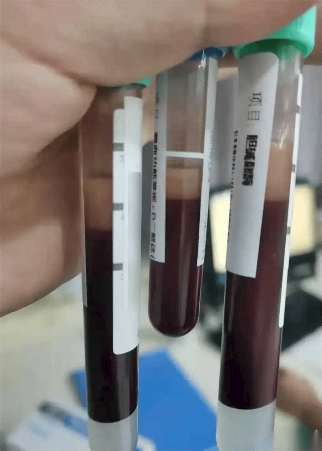 ﻿﻿阿德萊得城 vs 克罗伊登_一口气干掉5只﻿﻿﻿阿德萊得城 vs 克罗伊登，宁波男子被连夜送急诊！正大量上市！医生提醒：一次别超过2只