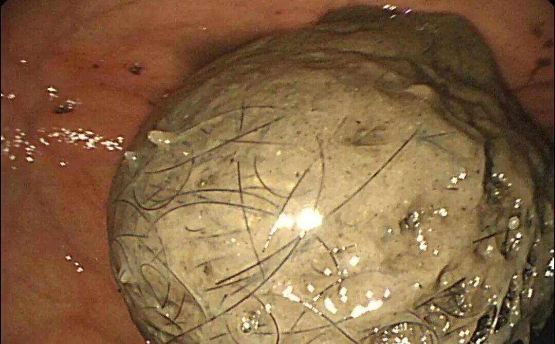 皇冠平台_发现一例皇冠平台,10岁女孩确诊!已有多起病例,有人因羞耻感延误就医